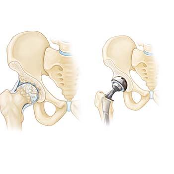 Hip-Replacement-Surgeon-in-Pune