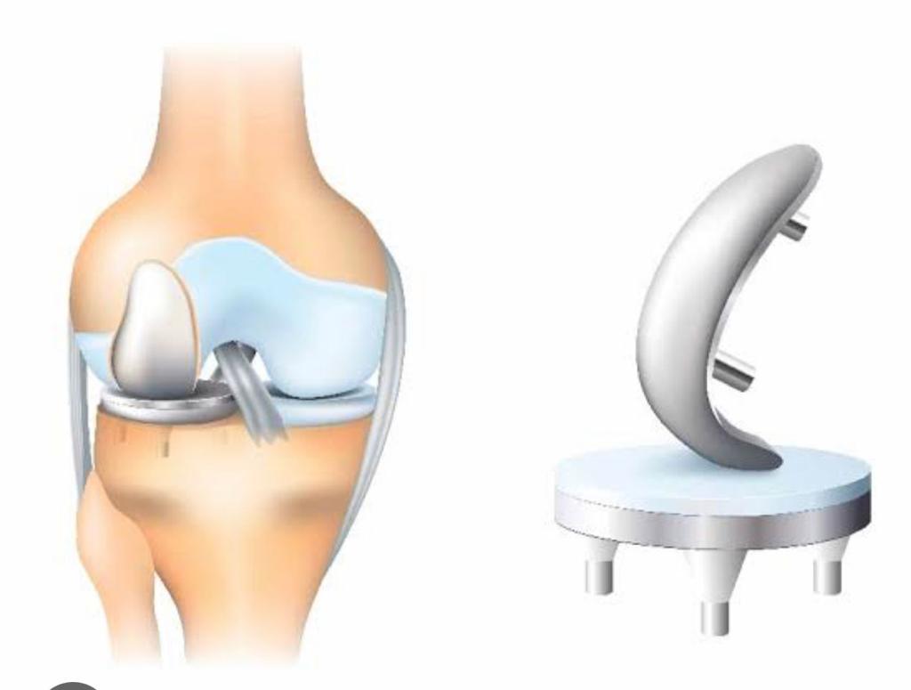 Unicompartmental/ Partial Knee Arthroplasty