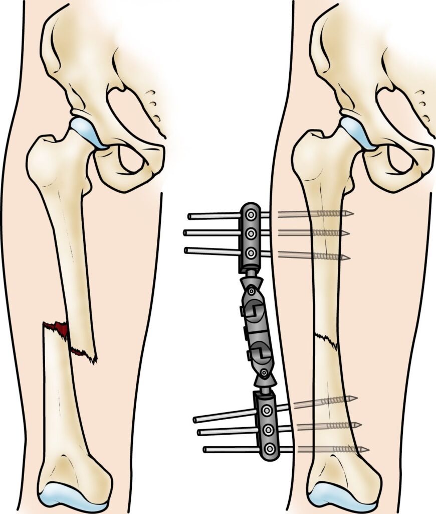 Dr. Sinukumar Bhaskaran – Orthopedic Trauma Specialist in Pune