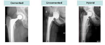 Dr. Sinukumar Bhaskaran – Hip Replacement Surgeon in Pune