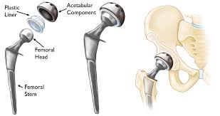 Dr. Sinukumar Bhaskaran – Hip Replacement Surgeon in Pune