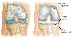 Robonavigation (Software Guided Surgery) Total knee replacement (TKR) with ROBONAVIGATION in Pune