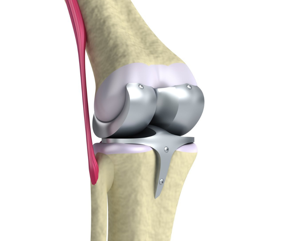 Fast Track Total Knee Replacement Surgeon in pune